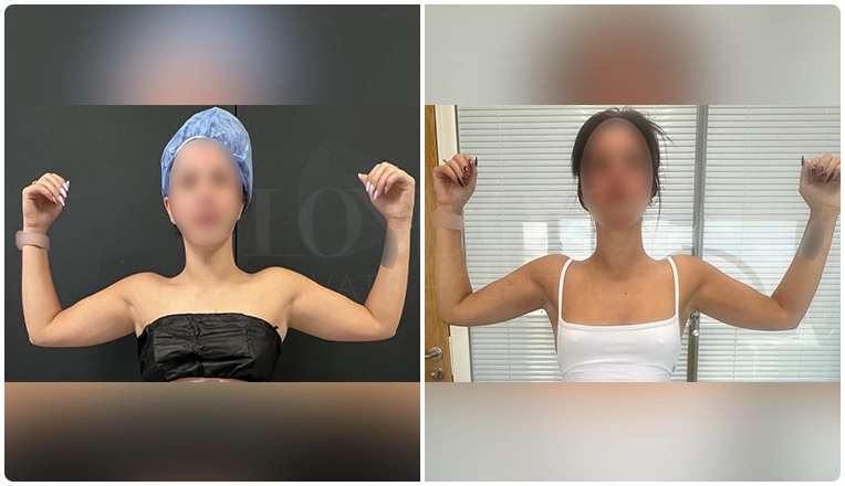vaser liposuction to upper arms and upper outer back result