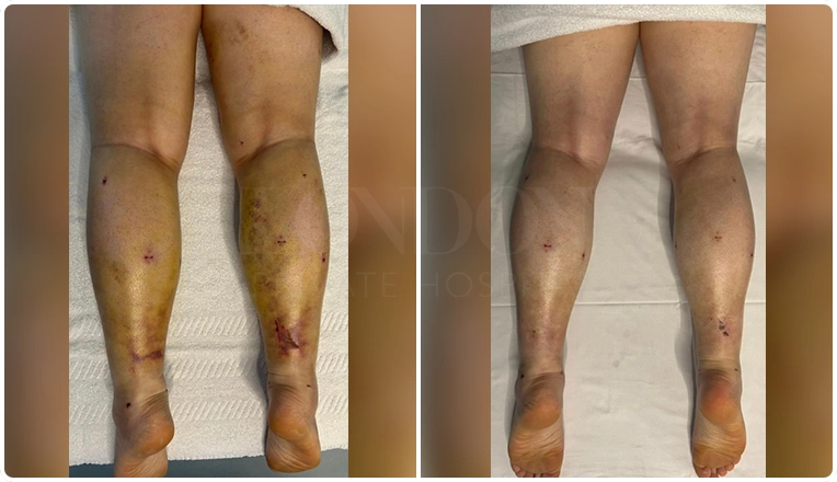 3-weeks-post-liposuction-mld-massage-before-and-after-result