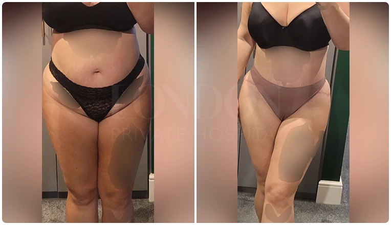 abdominoplasty-before-and-after-patient