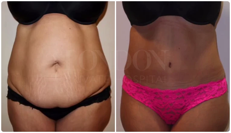 tummy-tuck-before-and-after-patient