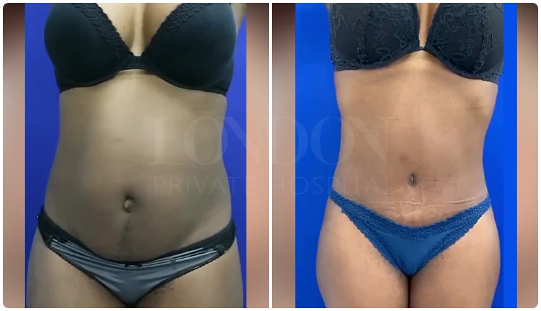 tummy-tuck-before-and-after-patient