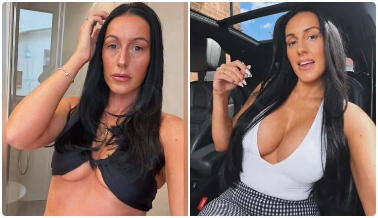 500cc-breast-implants-before-and-after-result