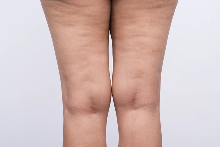 Thighs and knees showing possible lipoedema leg symptoms