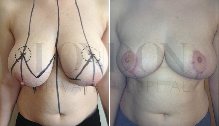 Breast reduction BA4