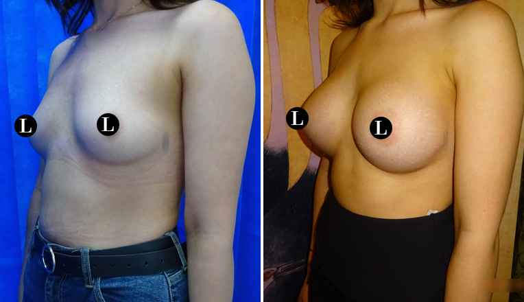 breast augmentation before and after-29