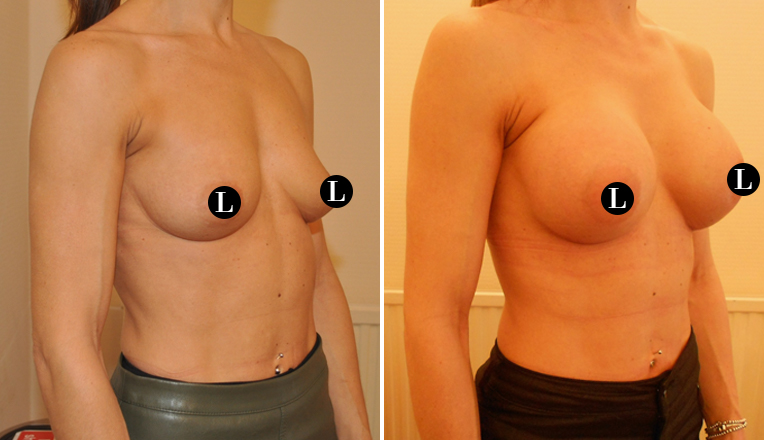 breast augmentation before and after-30