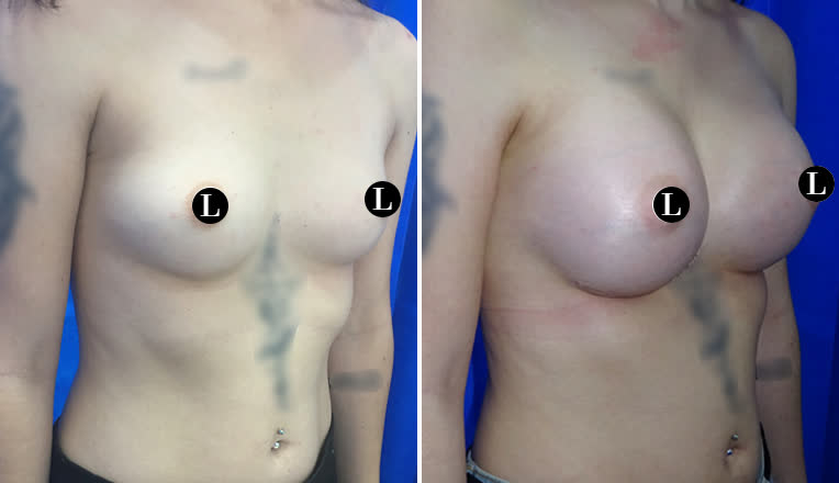 breast augmentation before and after-33