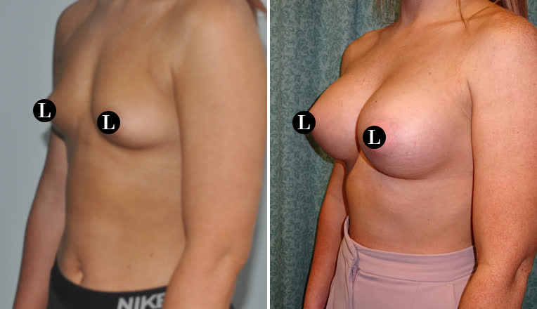 breast augmentation before and after-34