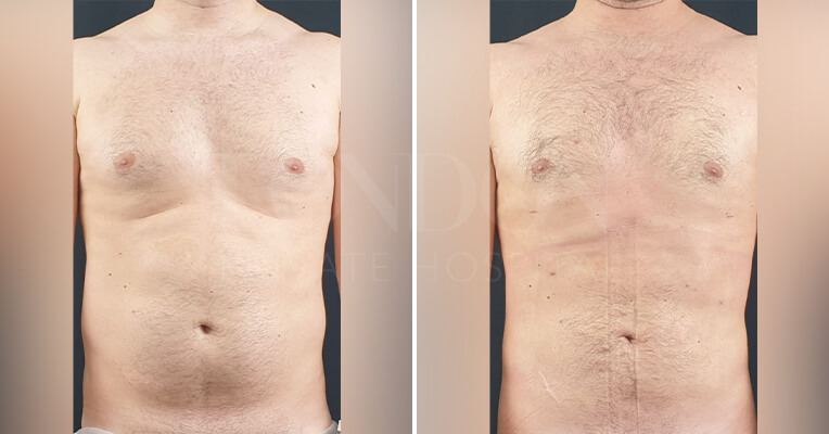 gynecomastia before and after-2