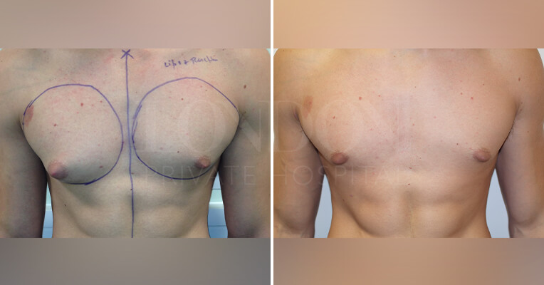 gynecomastia before and after-3