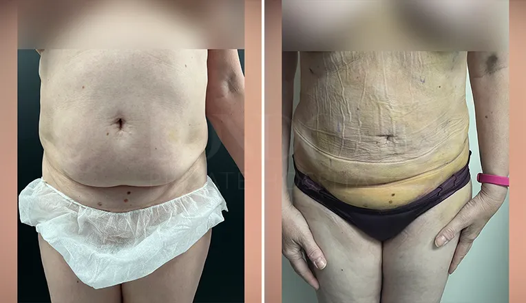belly liposuction before and after-1