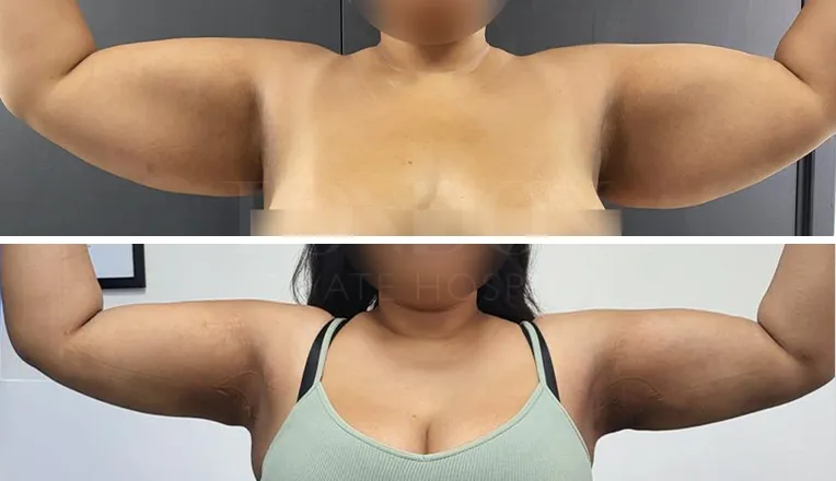 brachioplasty before and after patient-1