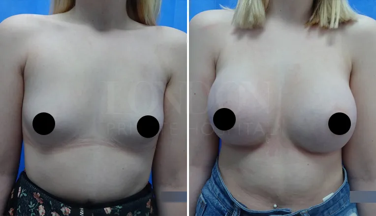 breast enlargement before and after-2