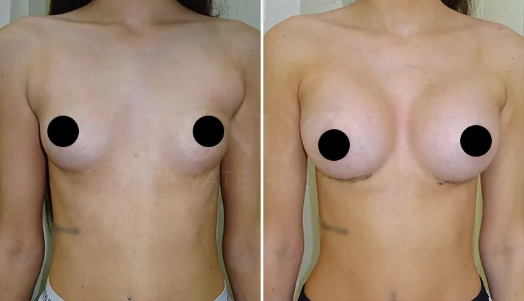 breast enlargement before and after patient-1