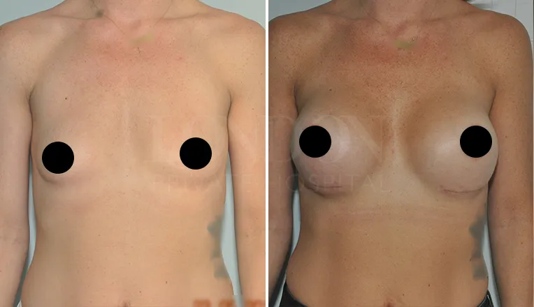 breast enlargement before and after patient-3