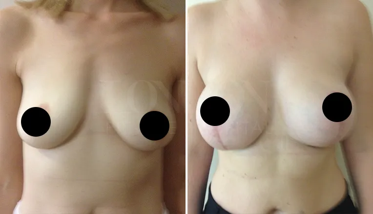 breast lift before and after patient-3
