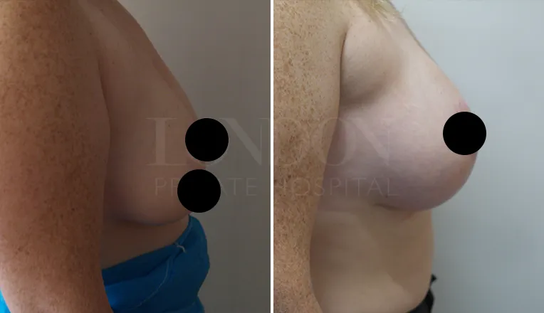 breast lift surgery before and after patient-1-2