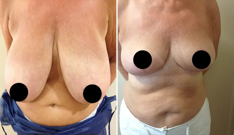 breast reduction before and after patient-1