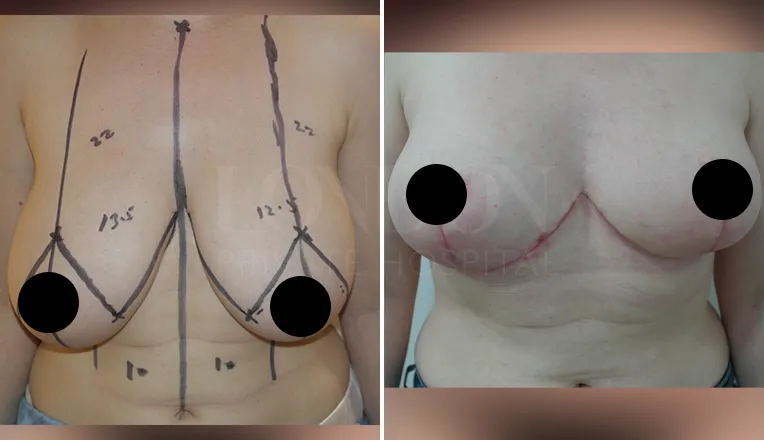 breast reduction surgery before and after-1