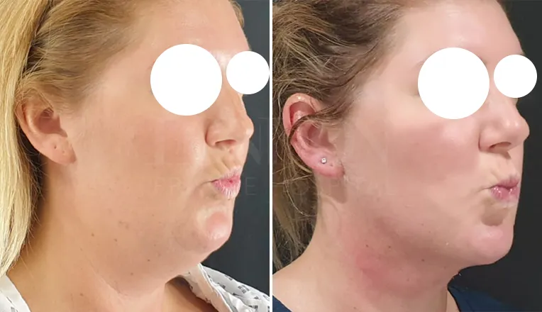 double chin liposuction before and after patient-1-2