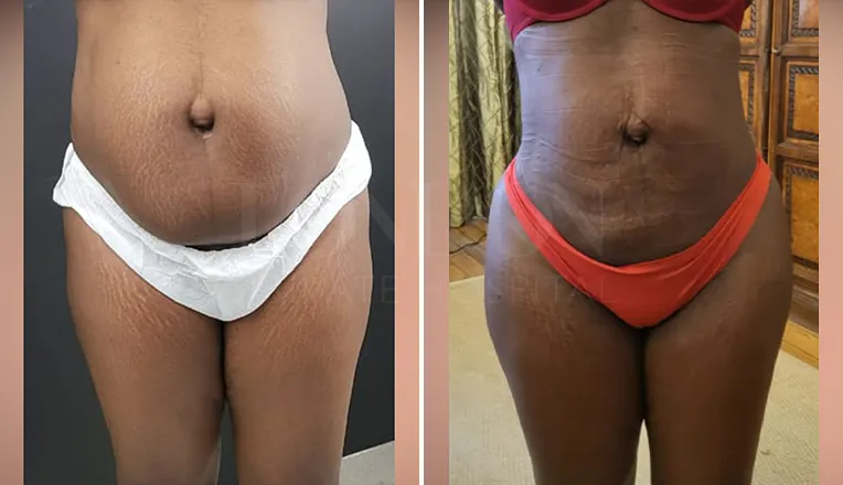 liposuction before and after stomach-2