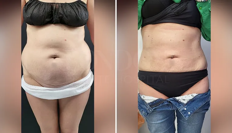 liposuction belly before and after-3