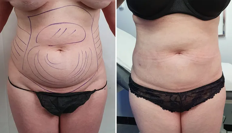 stomach liposuction before and after-2