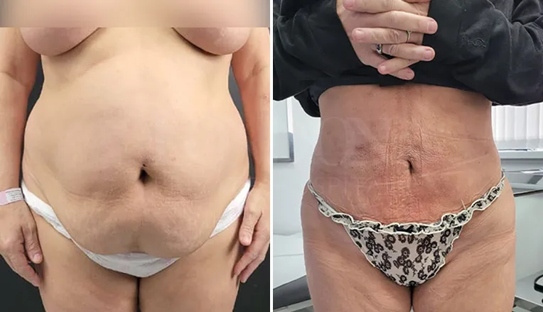 tummy liposuction before and after-1