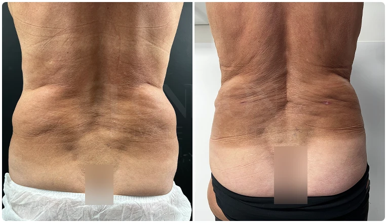 back vaser lipo before and after patient result-1