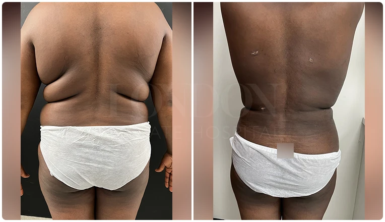 back vaser lipo before and after patient result-2