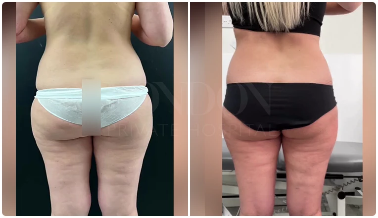 back vaser lipo before and after patient result-3