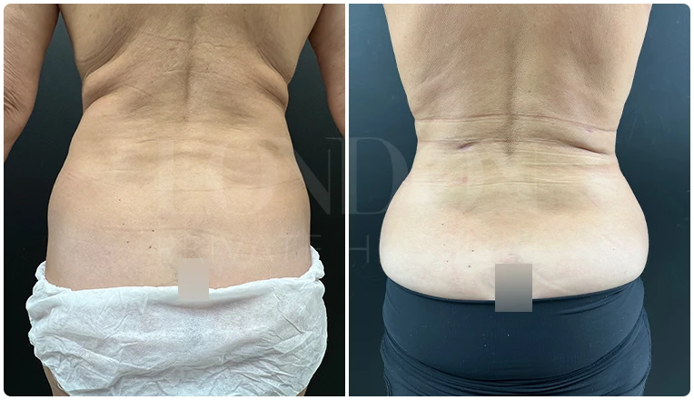 back vaser lipo before and after patient result-4