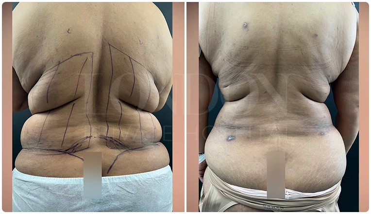 back vaser lipo before and after patient result