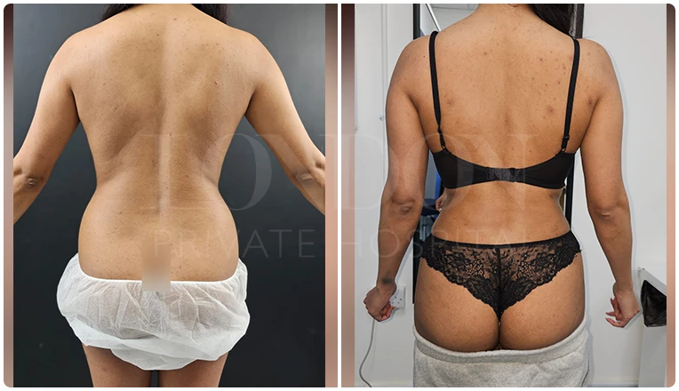 back vaser liposuction before and after patient-1