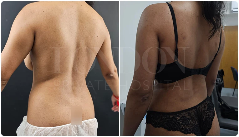back vaser liposuction before and after patient-2-v1