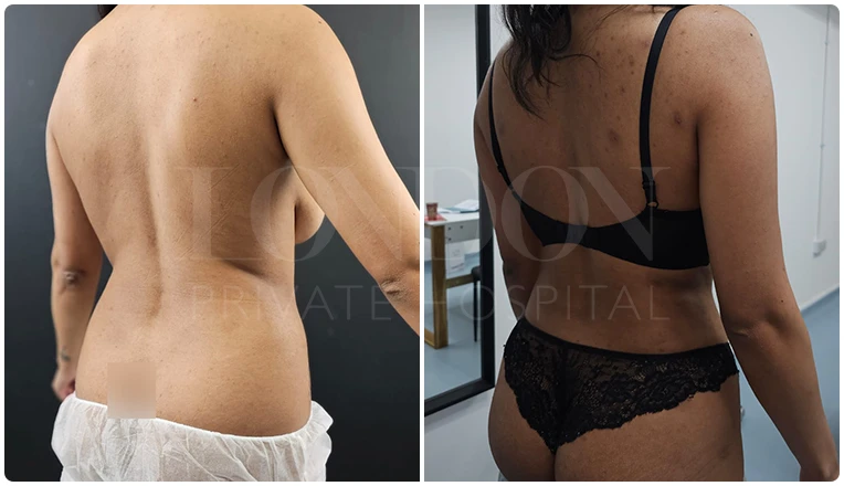 back vaser liposuction before and after patient-2-v2