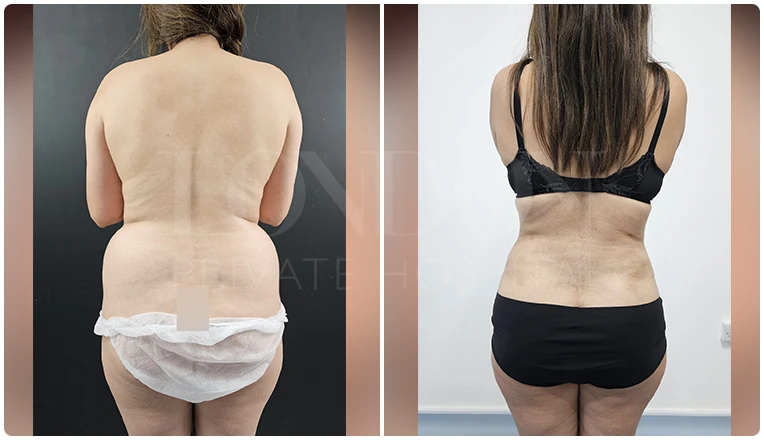 back vaser liposuction before and after patient-2