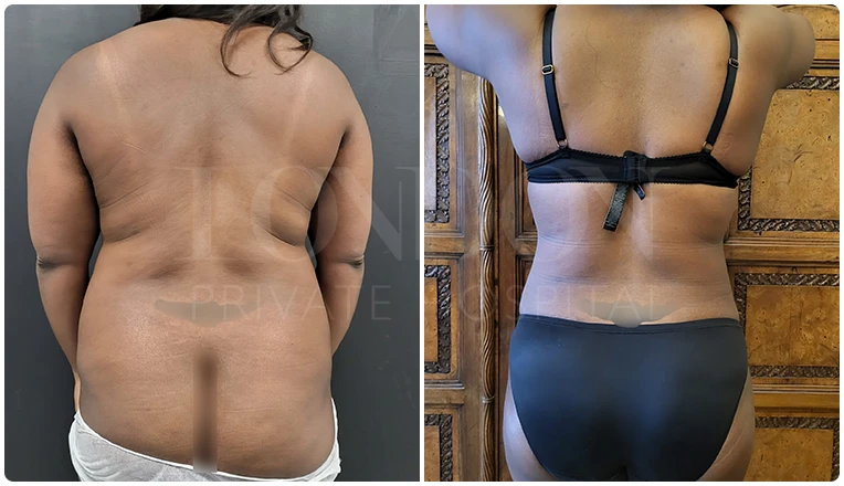 back vaser liposuction before and after patient-3