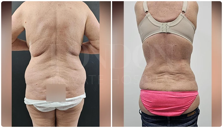 back vaser liposuction before and after patient