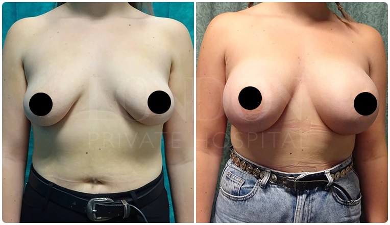 breast augmentation before and after patient-1