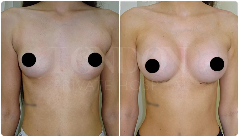 breast augmentation before and after patient-2