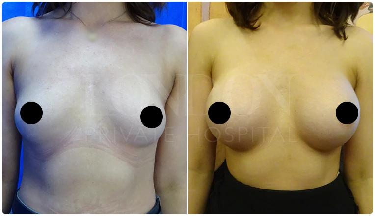 breast augmentation before and after patient-3