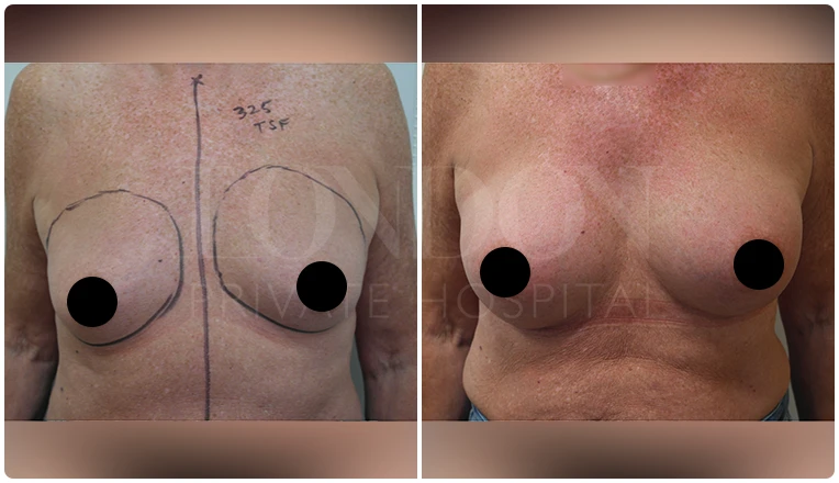 breast augmentation before and after patient-4