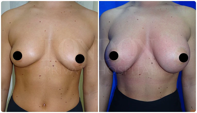 breast augmentation before and after patient-5