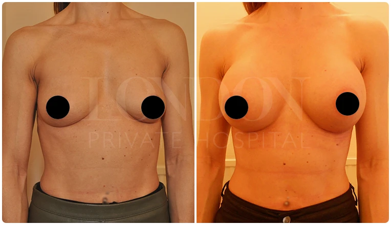 breast augmentation before and after patient-6