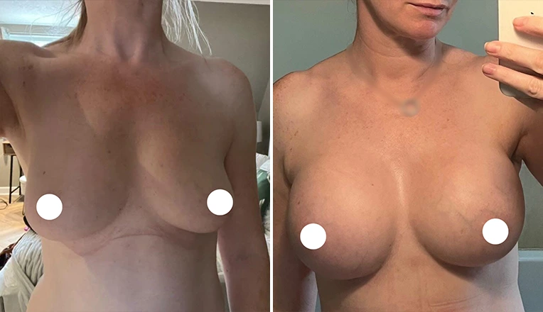 breast-augmentation-before-and-after-results