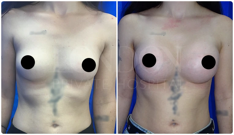 breast enlargement before and after patient-10