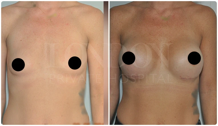 breast enlargement before and after patient-11