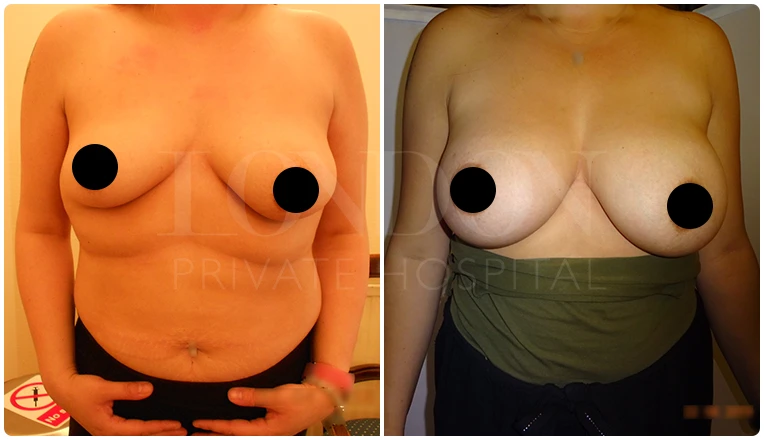breast enlargement before and after patient-12