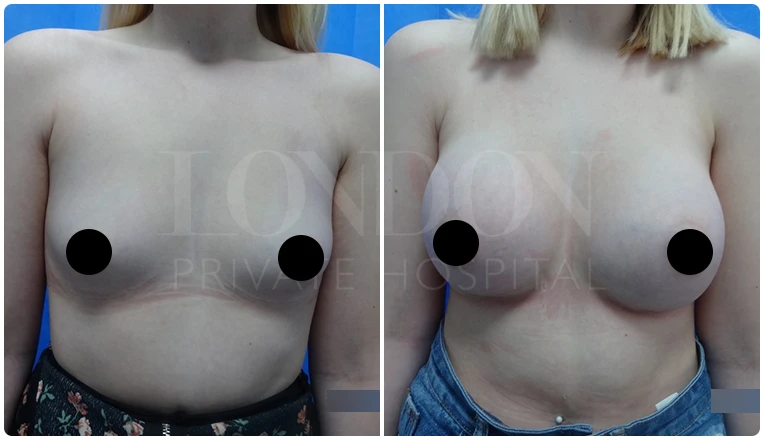 breast enlargement before and after patient-13